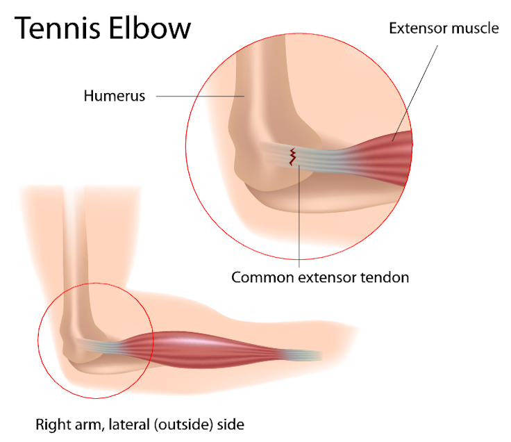 Pickleball Elbow (Tennis Elbow) - Symptoms, Prevention, and